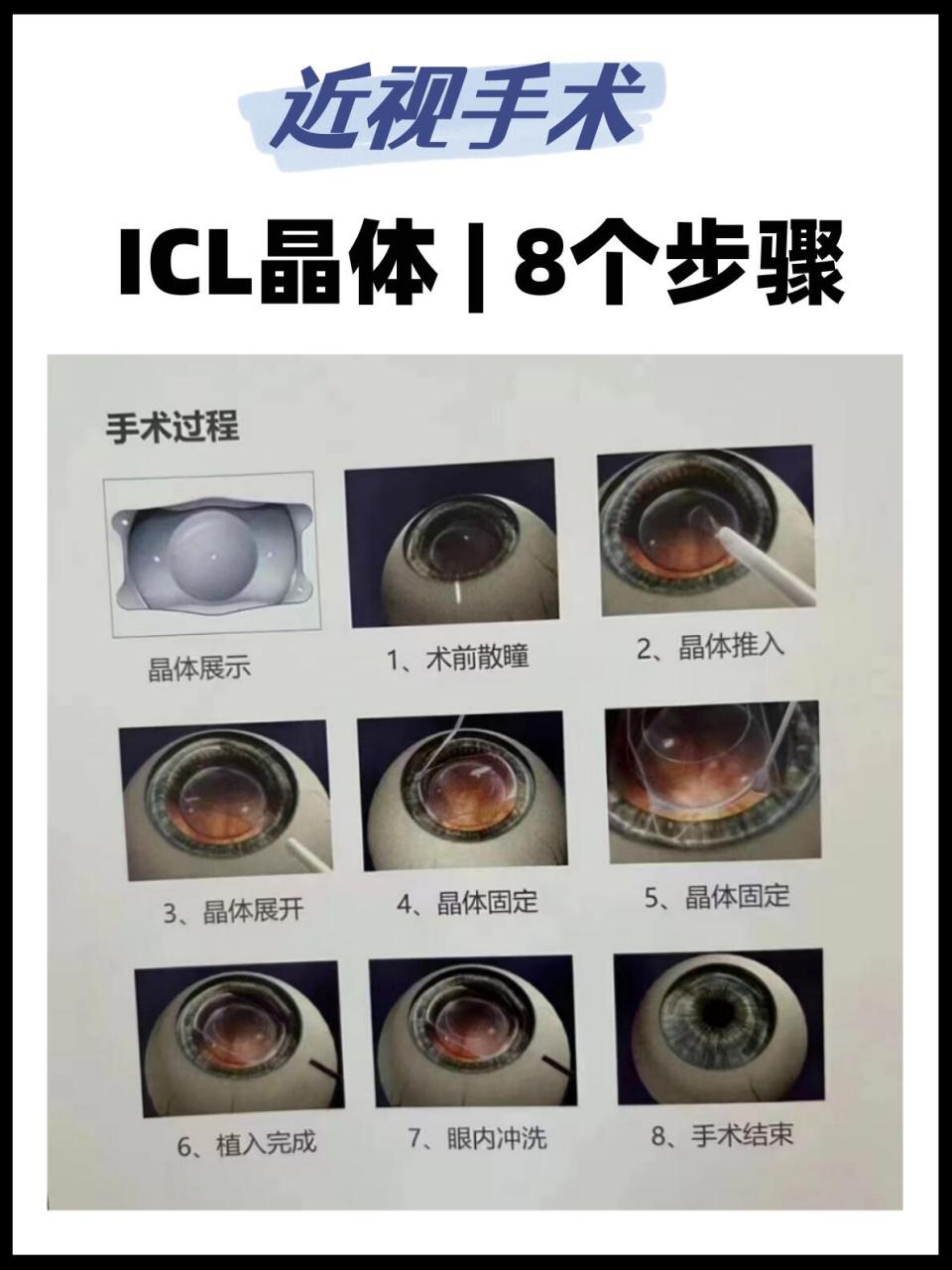icl晶体植入手术 | 8 个 步骤解析! 971.