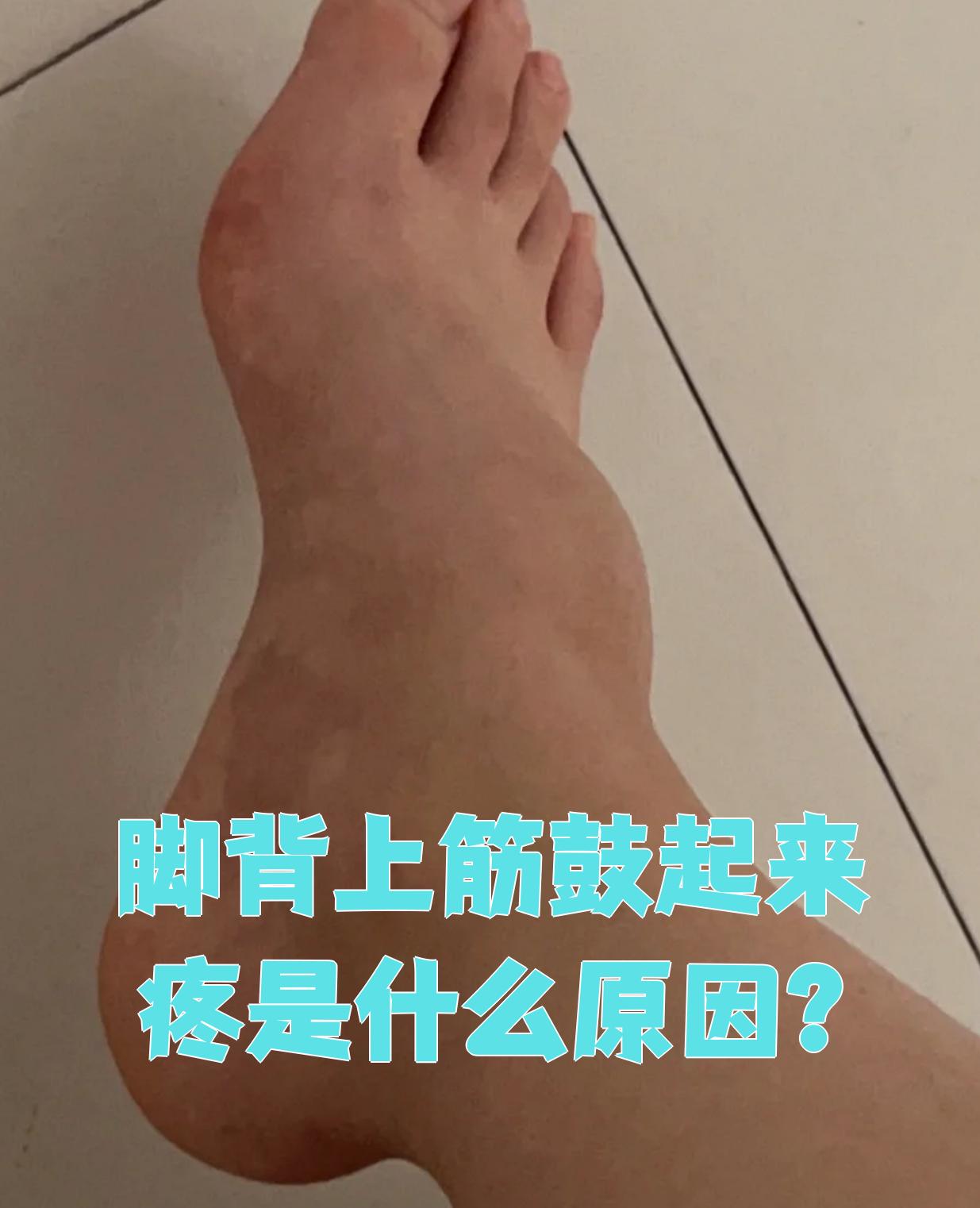 先说浅表性静脉炎