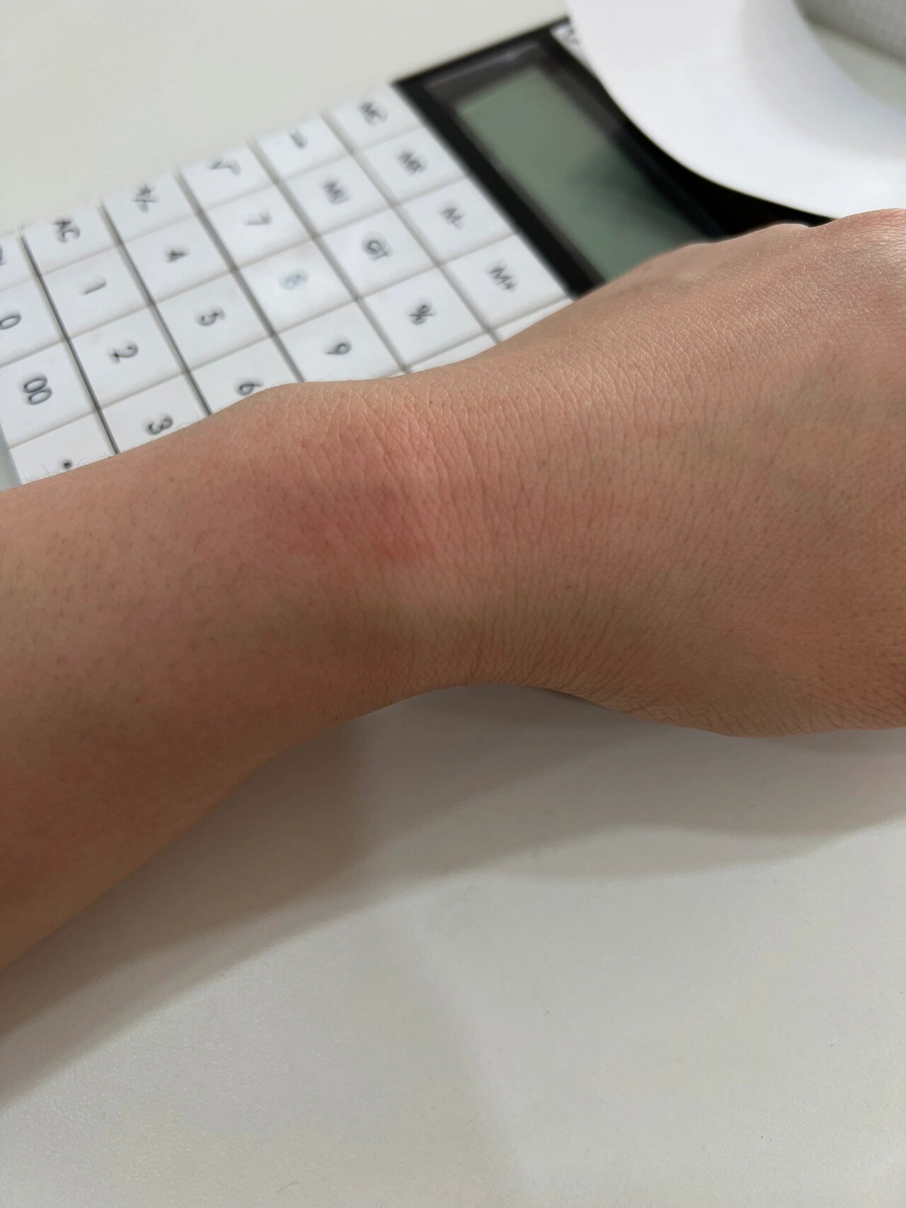 戴手表,手腕过敏.有好的解决办法吗