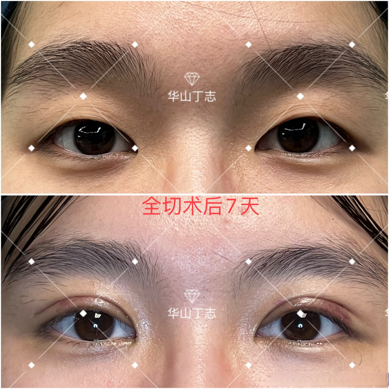 案例展示:全切双眼皮术后七天,自然款.