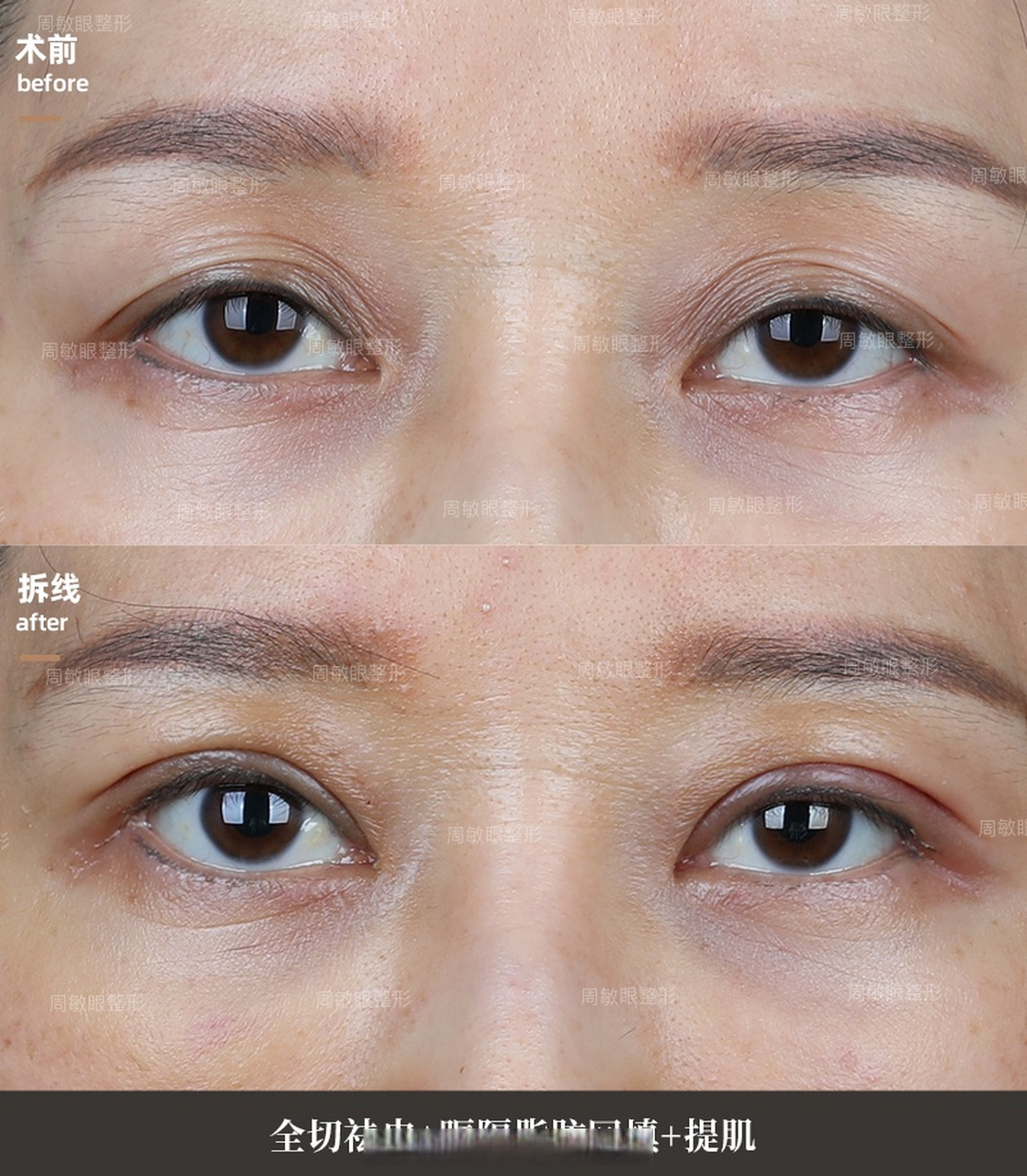 【眼球突出,多眼皮,三角眼】改善 美女是初眼,术前眼球凸出较为严重