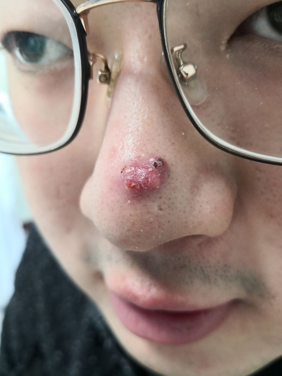 可以使用激光治疗配合药物口服涂擦.#囊肿性痤疮