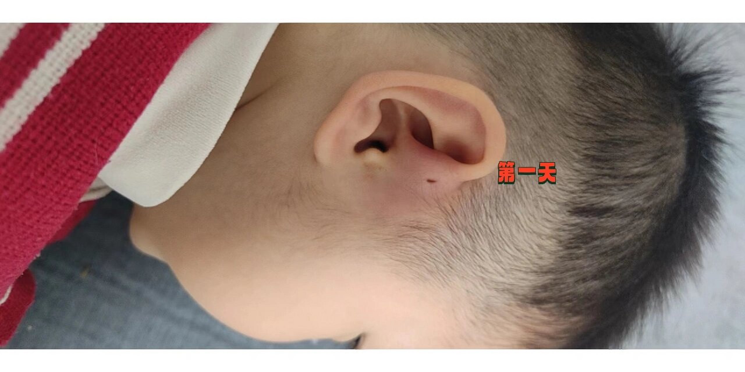 小崽子过了年耳仓红肿发炎了,吃了两天消炎药没管用,买了百多邦,抹了