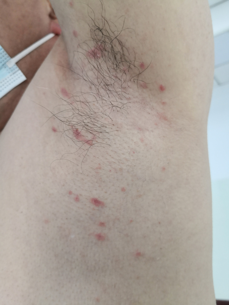 双侧腋下的红斑症状.马拉色菌阳性.考虑#玫瑰糠疹# 并发马拉色菌感染.