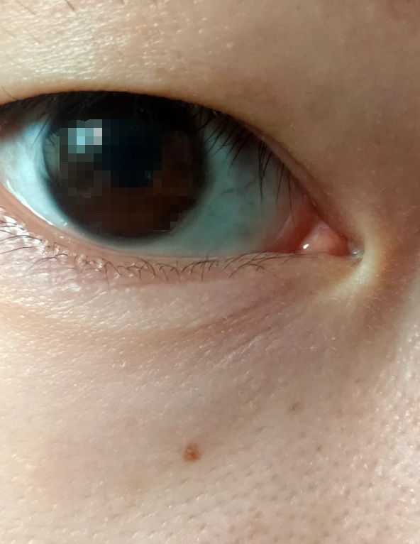 眼角长白色颗粒最常见的原因是结膜结石和麦粒肿