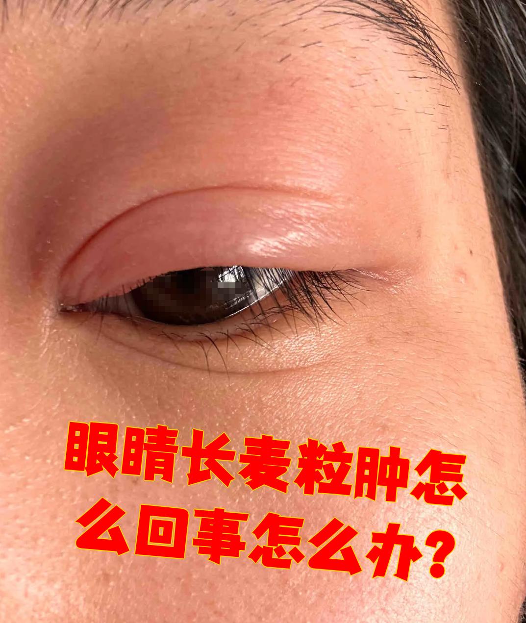 麦粒肿也叫针眼,是睫毛根部的皮脂腺或睑板腺发炎化脓了