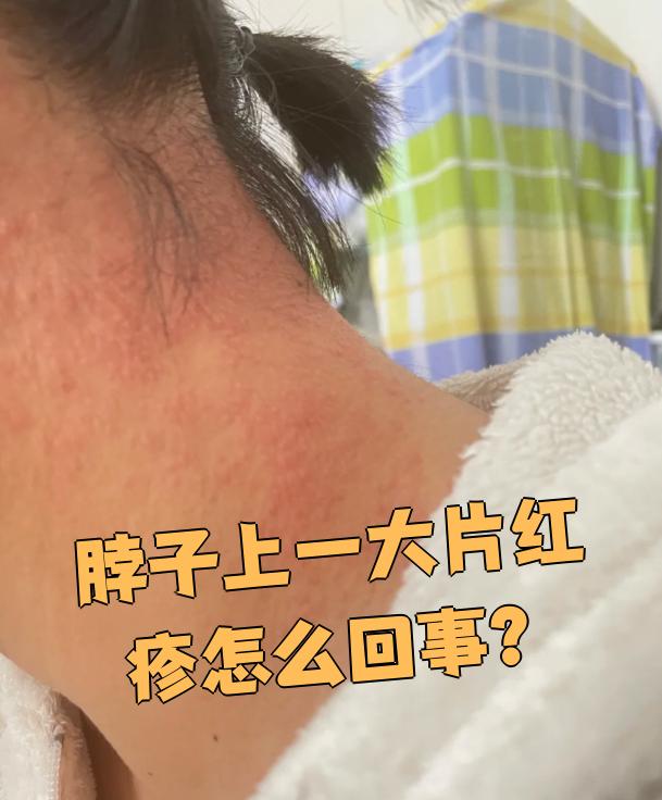 脖子上突然出现大片红疹,最常见的原因是痱子,接触性皮炎或荨麻疹
