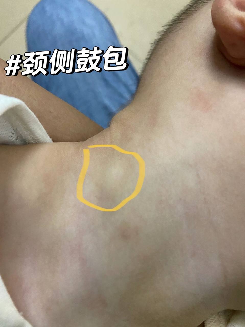 颈侧鼓包 宝宝8个半月,突然发现他右侧脖子上有个小小的包,按下去滑滑