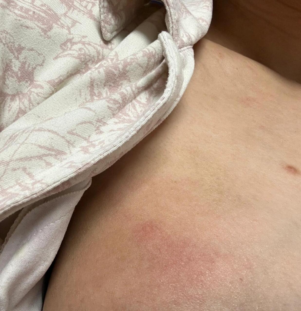 哺乳期硬块红肿😱 过年吃的有点油了,胸上的硬块红了好几天了,吃