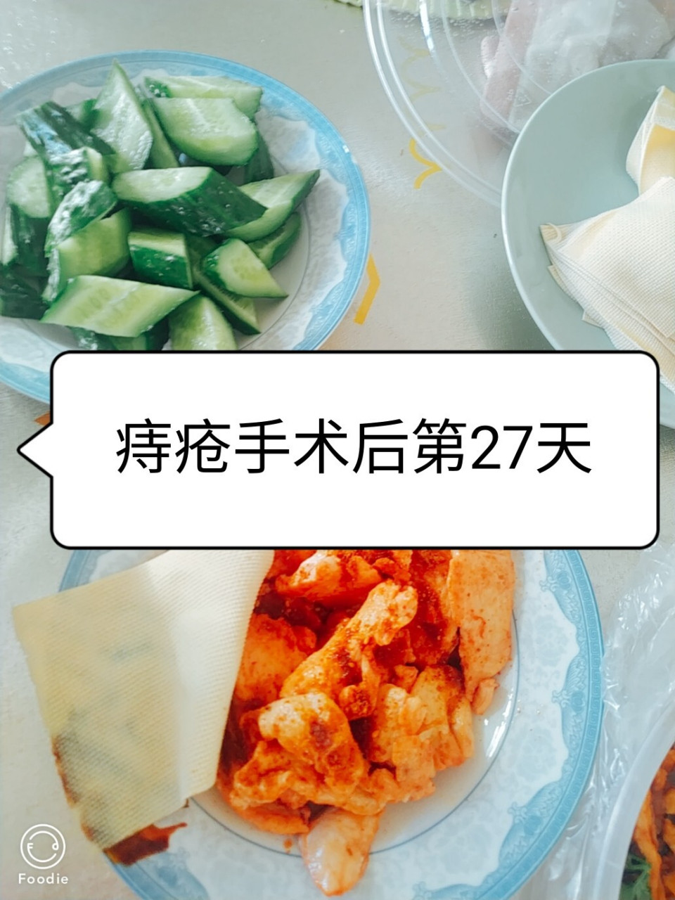 痔疮手术后第27天 昨天一天没有排便,最后一颗肛泰栓也已经用完了.