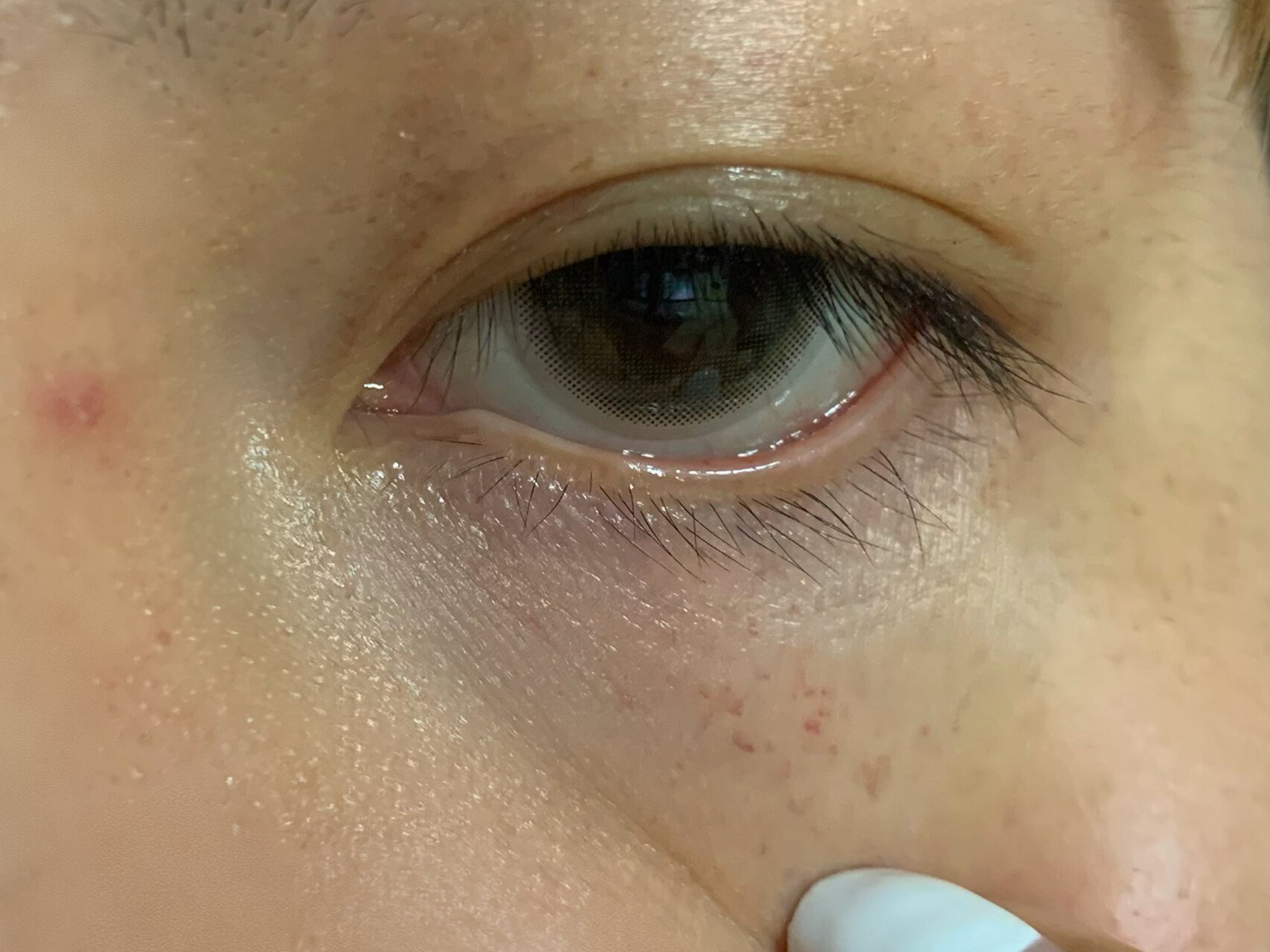 早上起来就发现眼周一圈都是红斑,过了一早上了一点褪的意思都没有 该