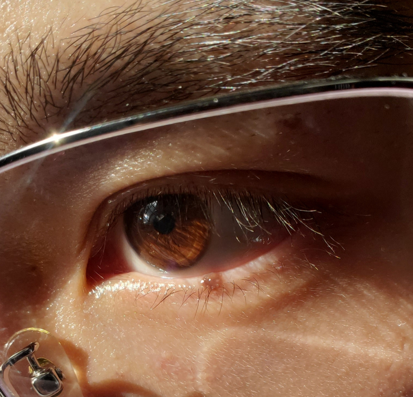 生平第一次看到长在下眼睑的痣 左眼下方泪痣 右眼下眼睑泪痣 比泪痣