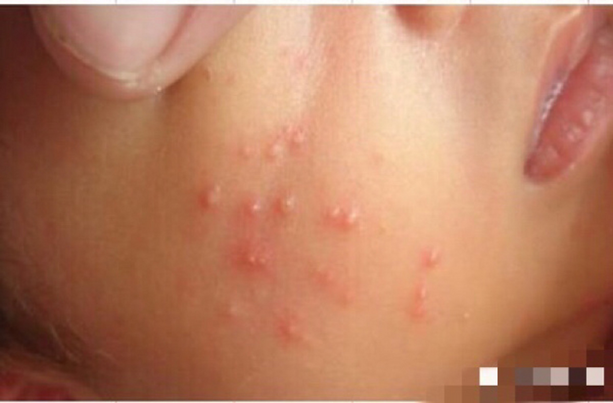 新生儿痤疮怎么办 有20%的宝宝会发生新生儿痤疮,多在宝宝出生后两