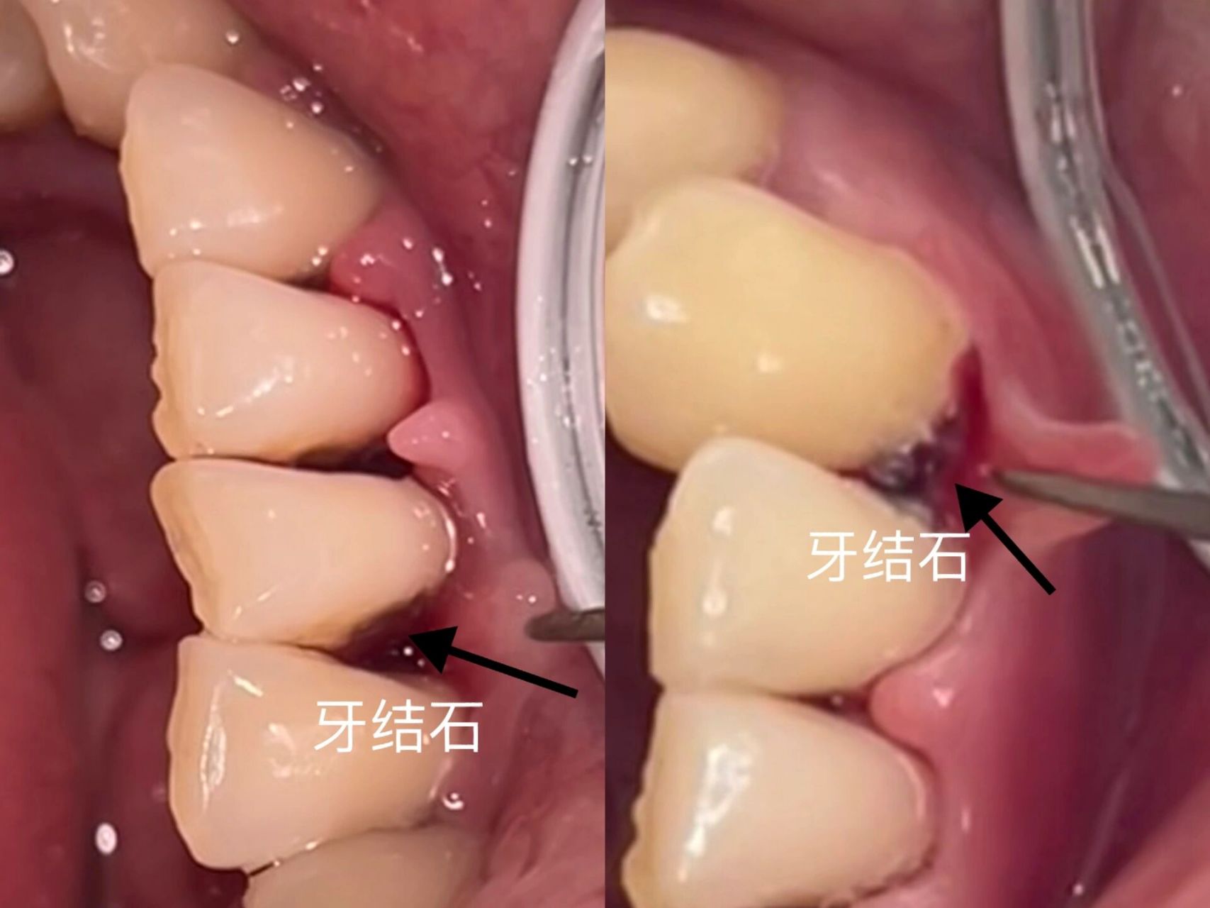 牙齿 注重牙齿健康,龈下菌斑结石引起牙龈红肿,牙龈附着丧失,牙齿松动