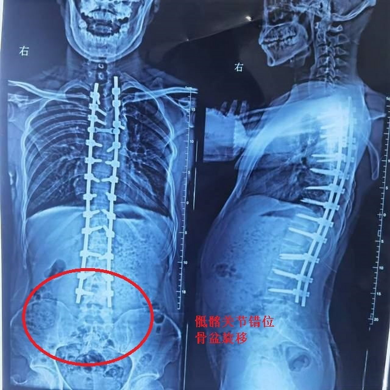 脊柱侧弯手术前腰痛,为什么手术后腰还是痛  最近有多位网友私信我,向