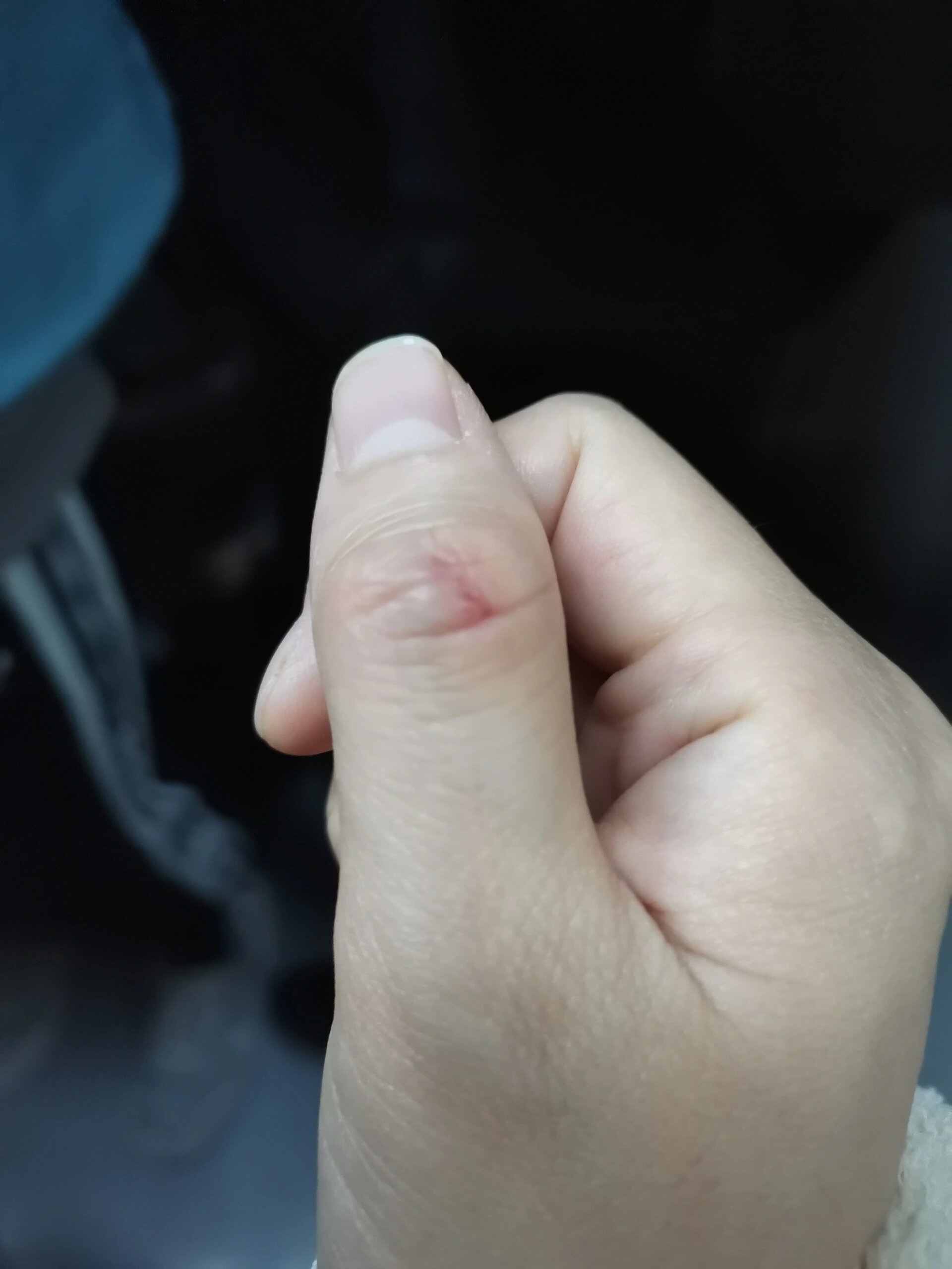 老鼠咬出血需要打狂犬疫苗吗?