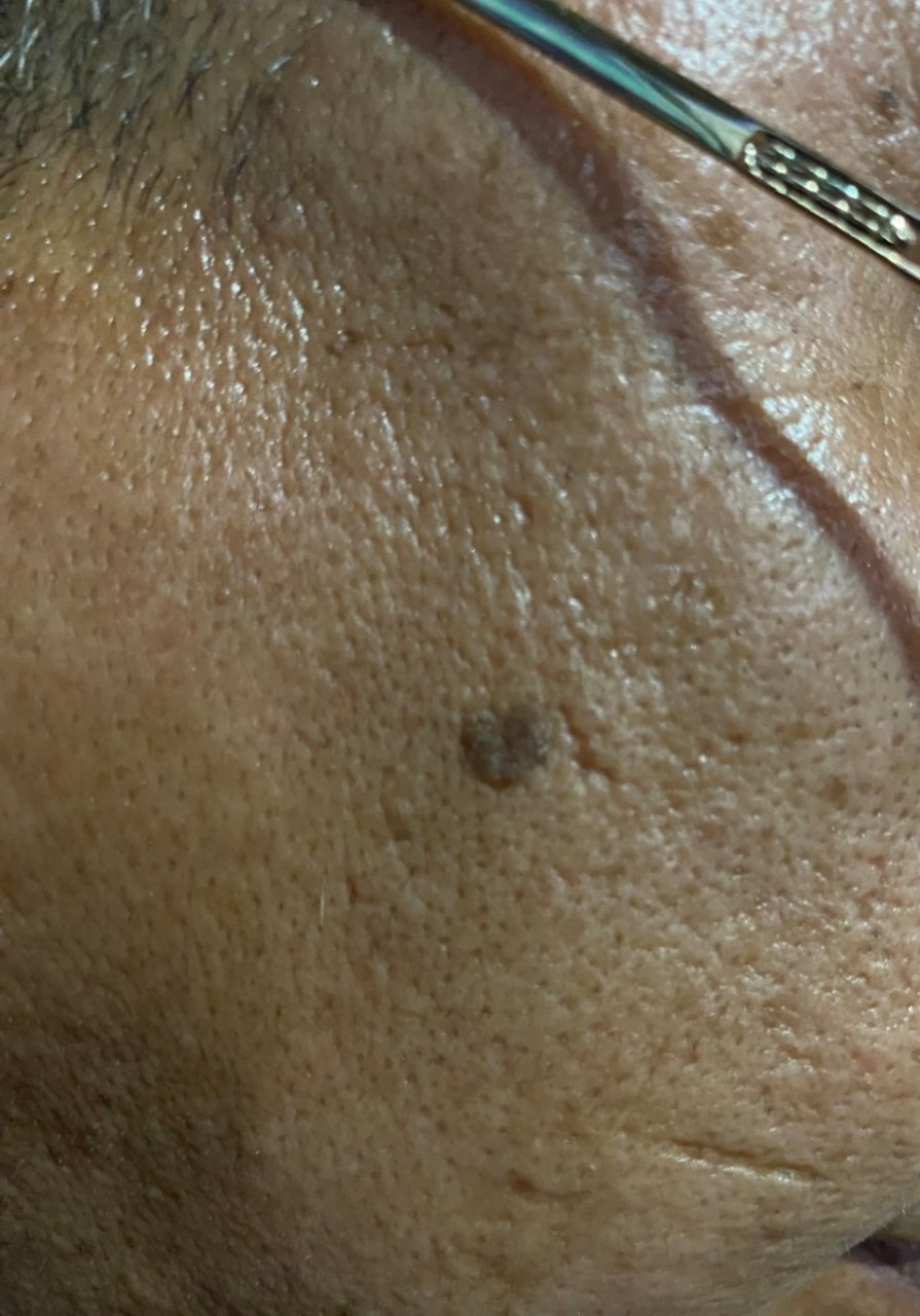 面部脂溢性角化/老年斑.激光治疗去除可以.操作简单方便效果可靠!#解