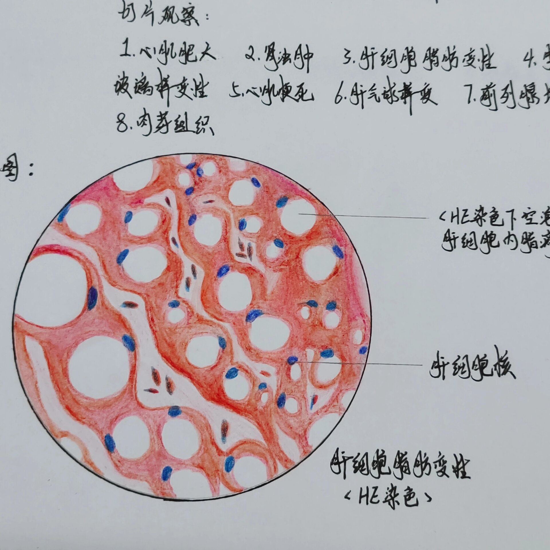 肝脂肪变性 红蓝图片