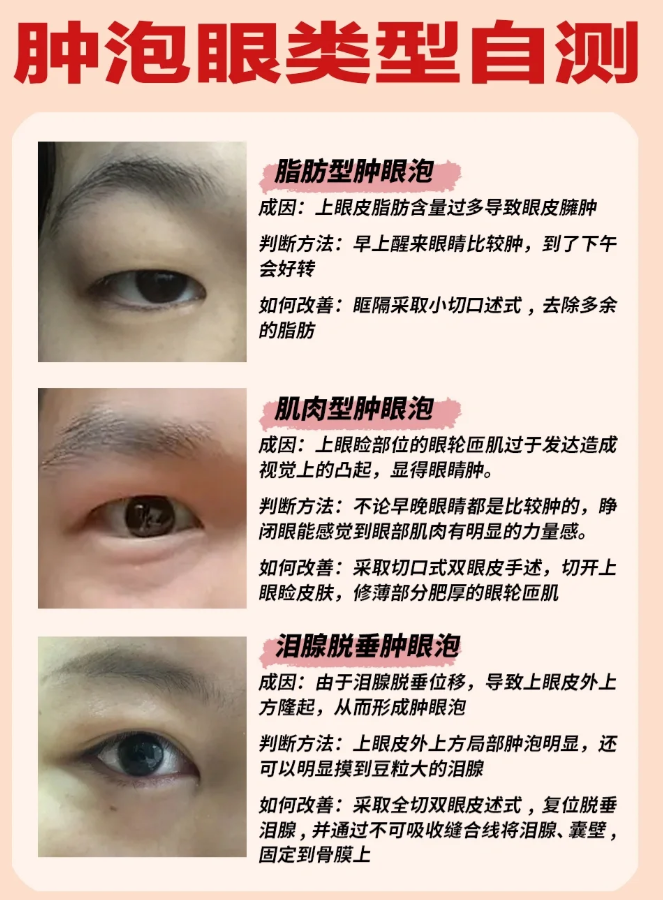 泪腺脱垂型肿眼泡