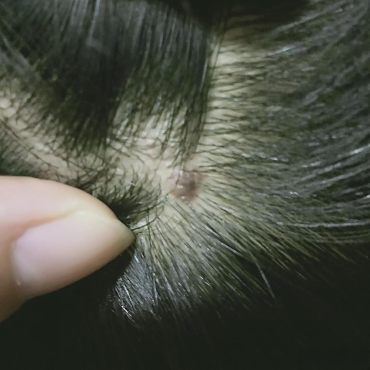 孩子头上有一个黑点,开始以为是一颗痣,没管它,刚才意外看到没想到长