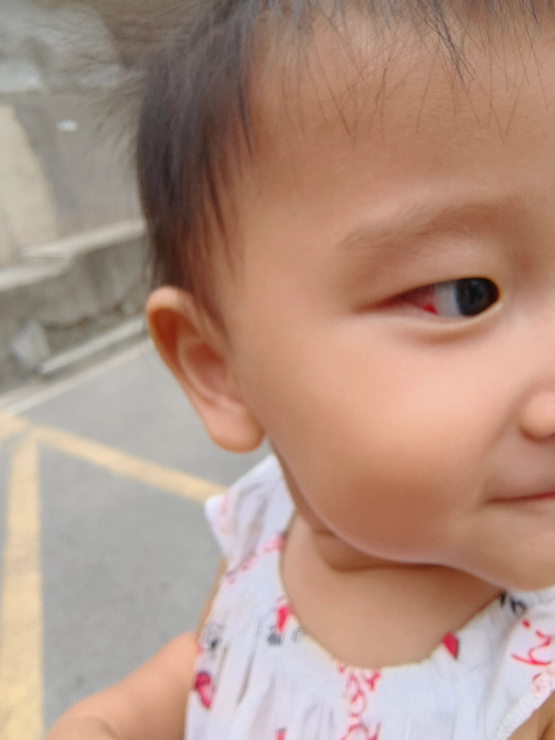 结膜下出血的宝宝 9.