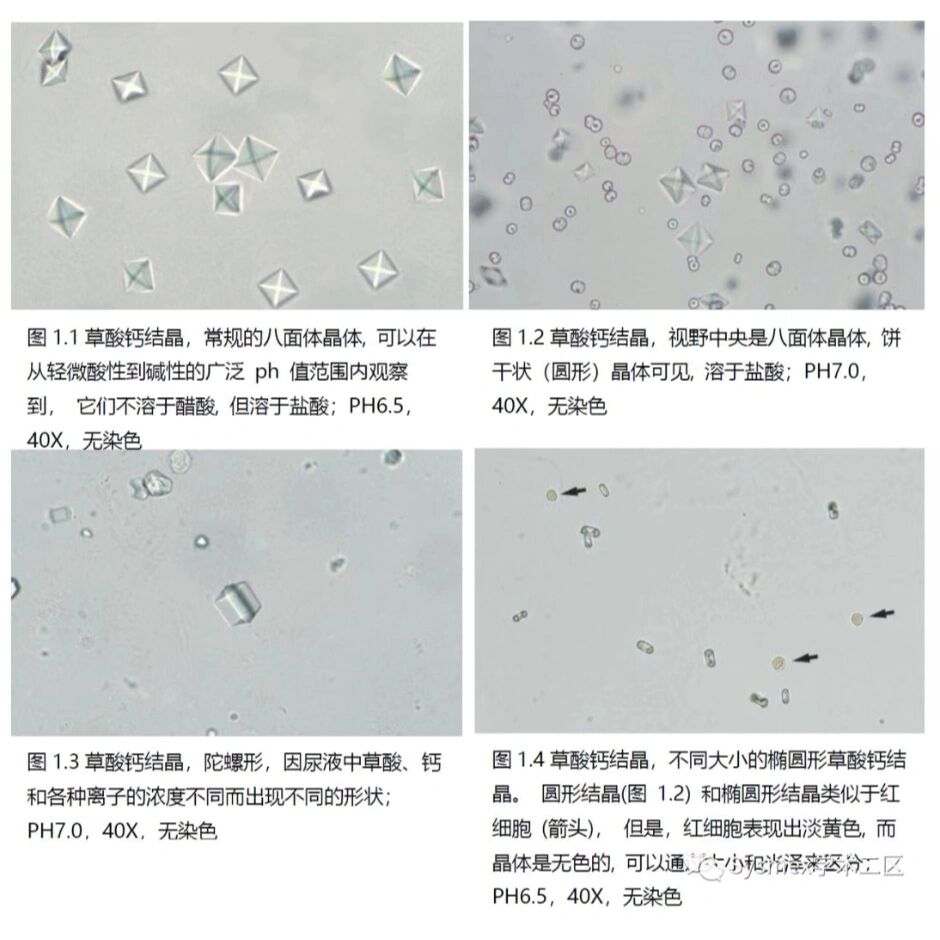 尿沉渣图谱结晶图片