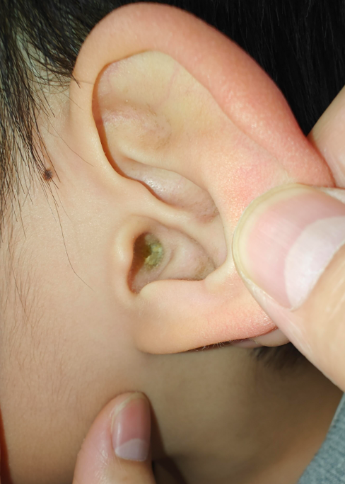 耳朵堵住了闷闷的感觉里面又没耳屎怎么回事?