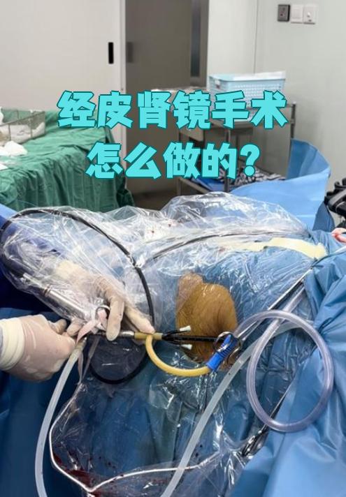 经皮肾镜手术也叫经皮肾镜碎石取石术,主要用于治疗肾结石