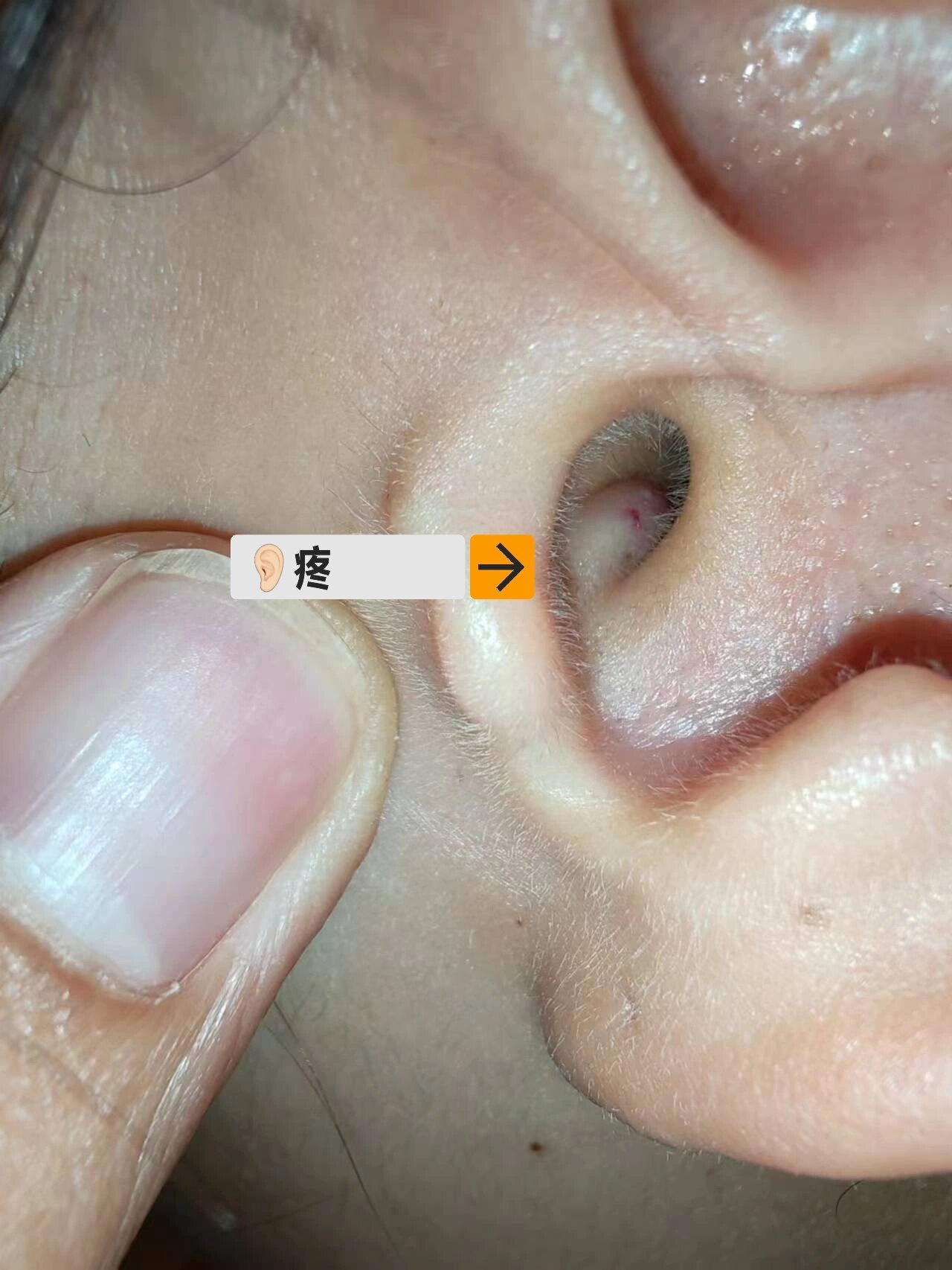 耳朵里的脓疮小白点 两天前,我耳朵里长了个脓包,又疼又红又肿,我判定