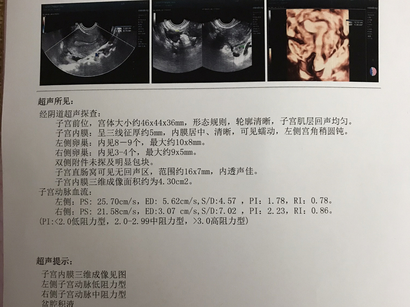 纵膈子宫三维彩超图片图片