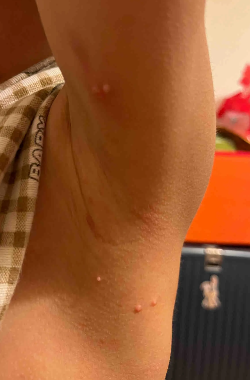 手上长肉疙瘩但不疼不痒,可能的原因有好几种
