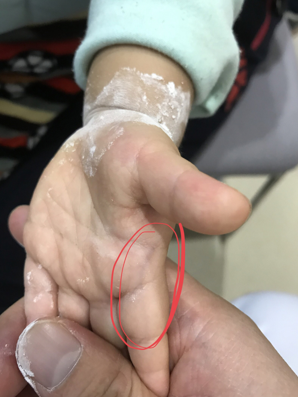 小儿指纹色紫红,家长要当心 小儿指纹的变化可以反映儿童的虚实寒热.
