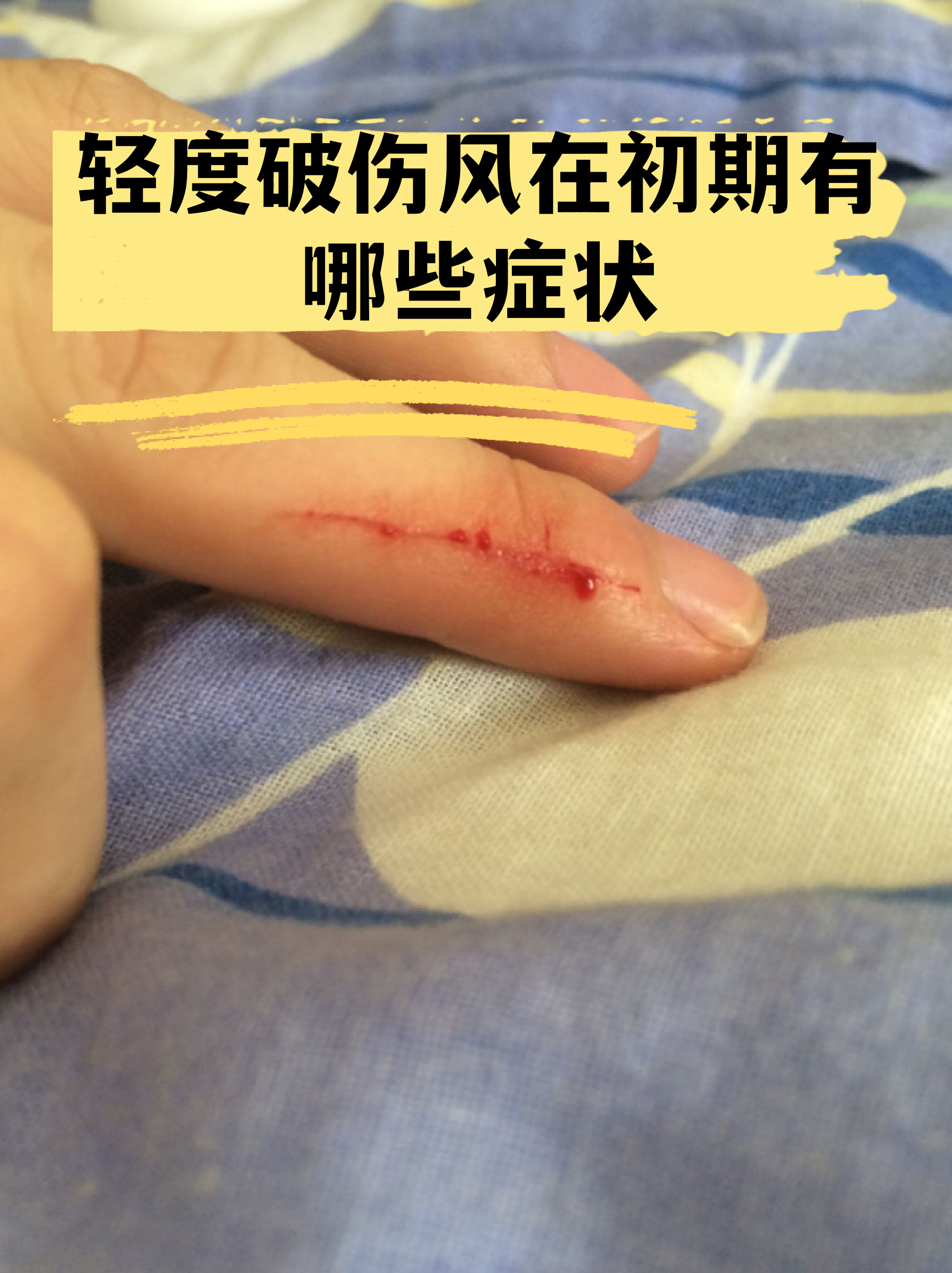 轻度破伤风在初期有哪些症状