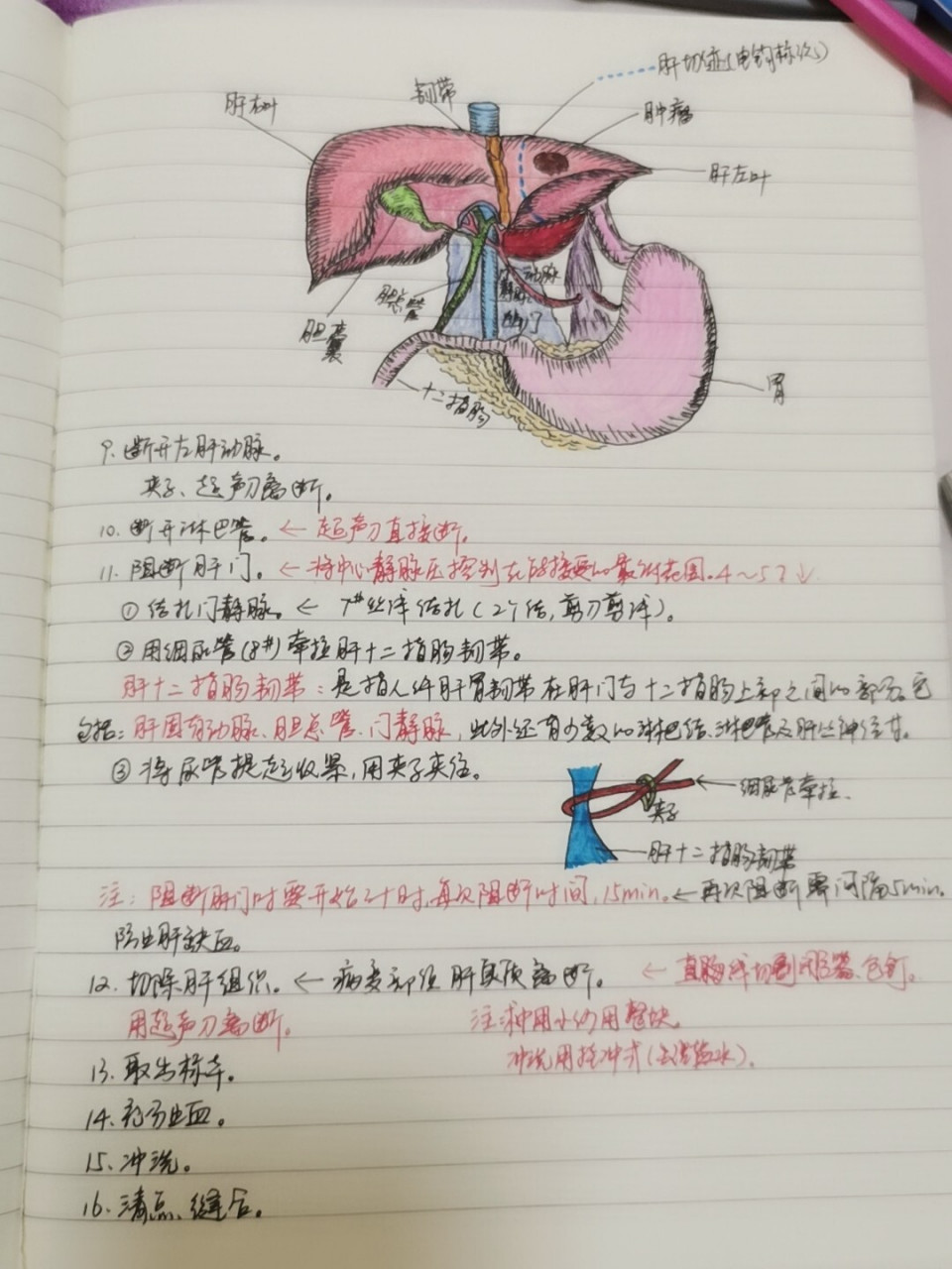 手术笔记:腹腔镜下肝叶切除术