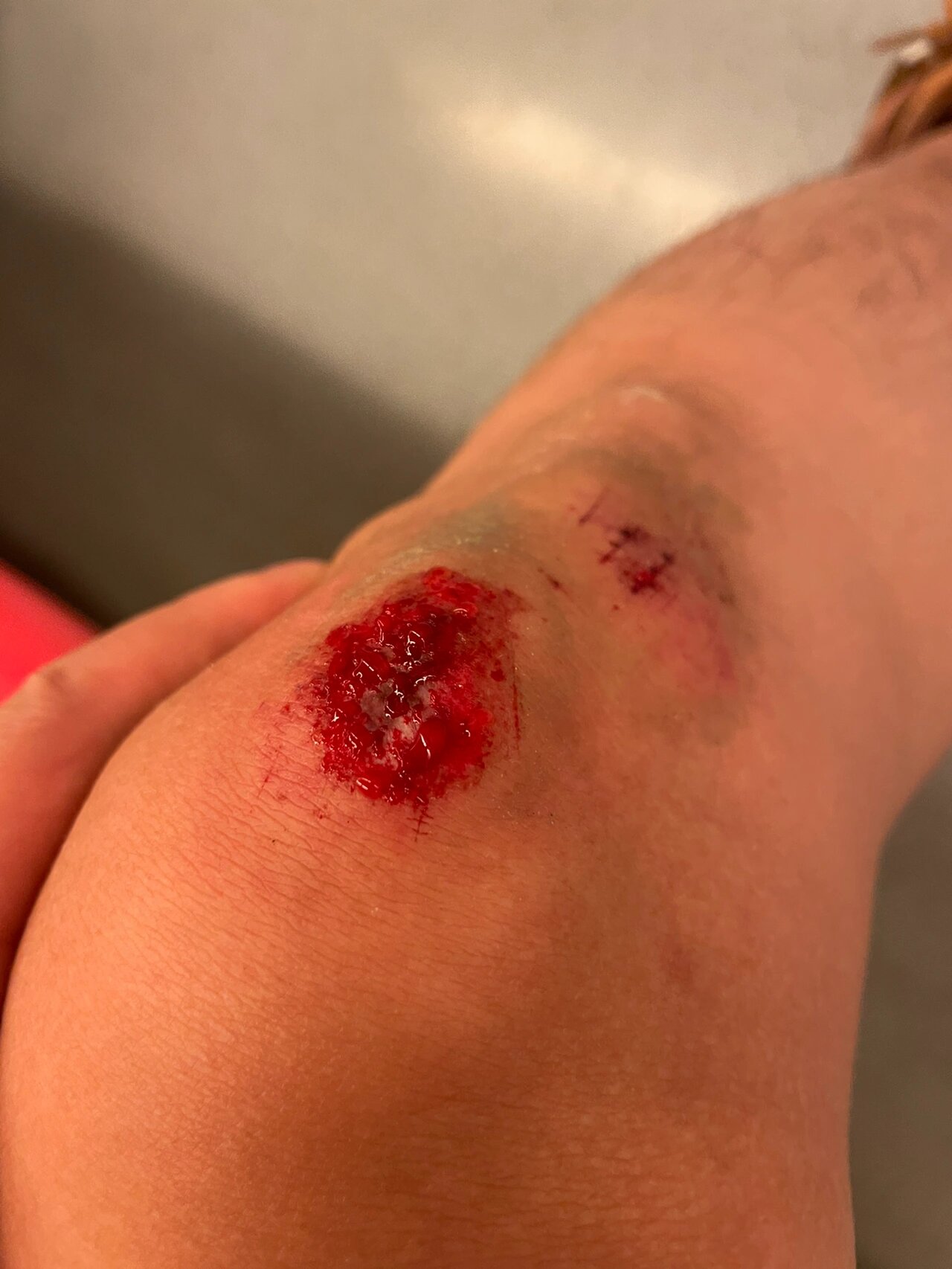 膝盖摔伤 多久能好🥹🥹