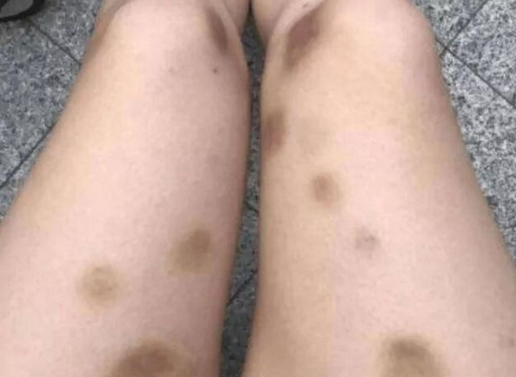 因为他身上突然青一块紫一块的,你看我特别着急.他很害怕是血液病.