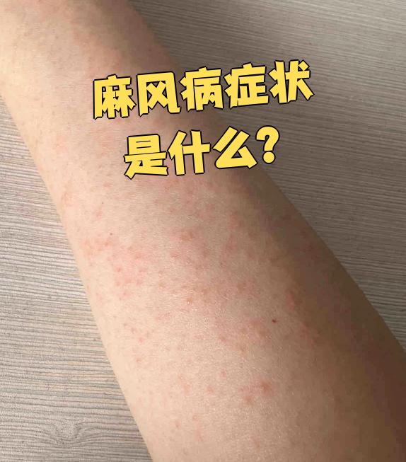 麻风病的症状主要出现在皮肤和神经上,不同阶段表现不一样