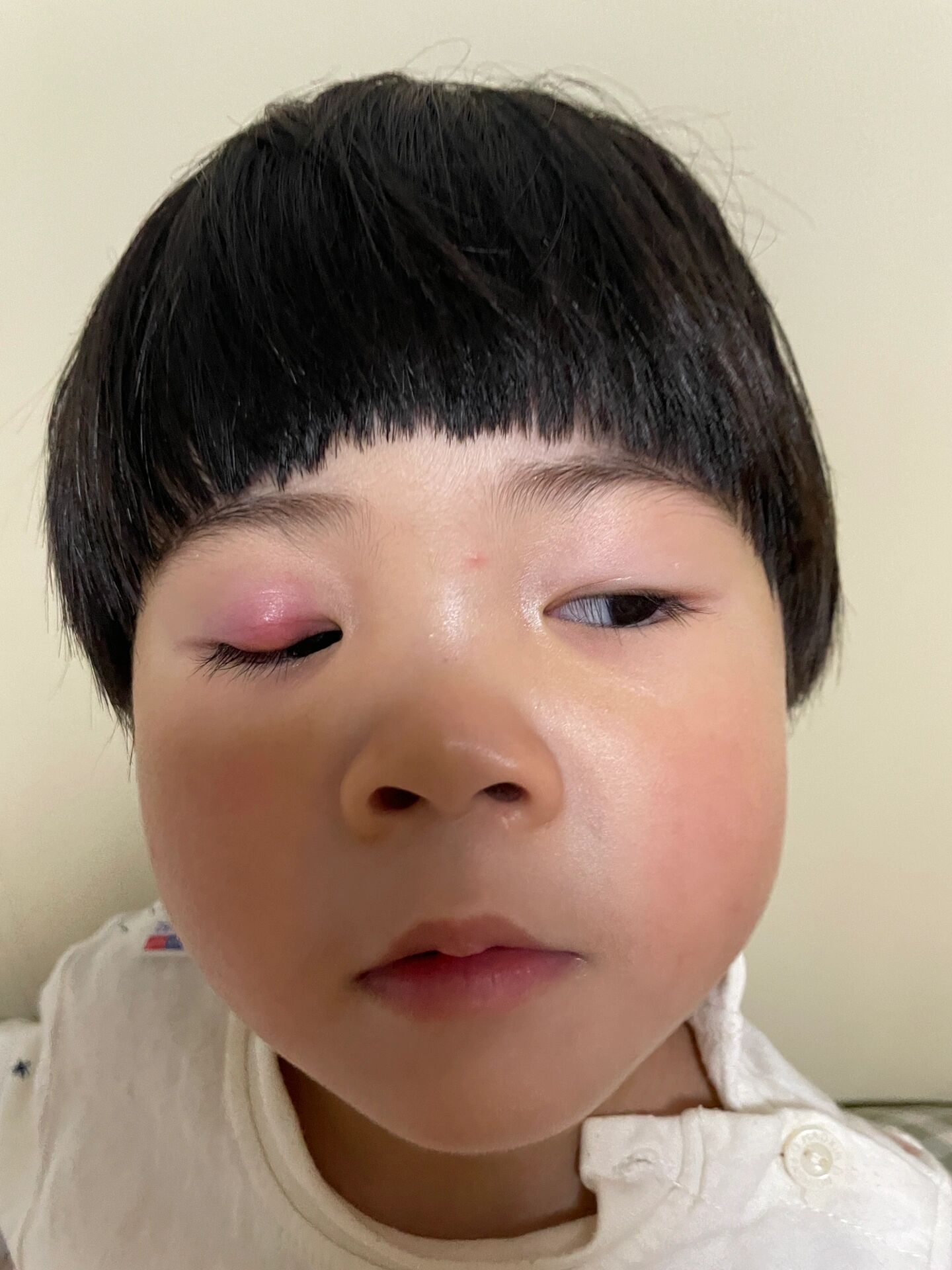 ⃣️为在今天早上破脓后的照片,没有完全消下去,可以肉眼看到脓包