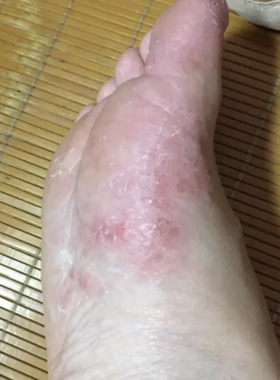 水泡就是水疱.脚气也叫足癣