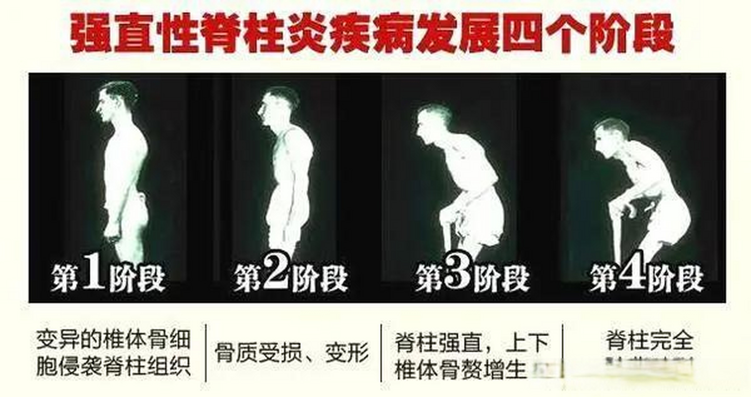 37岁小伙强直性脊柱炎3年,腰痛背痛胯骨痛,打生物制剂后染上肺结核