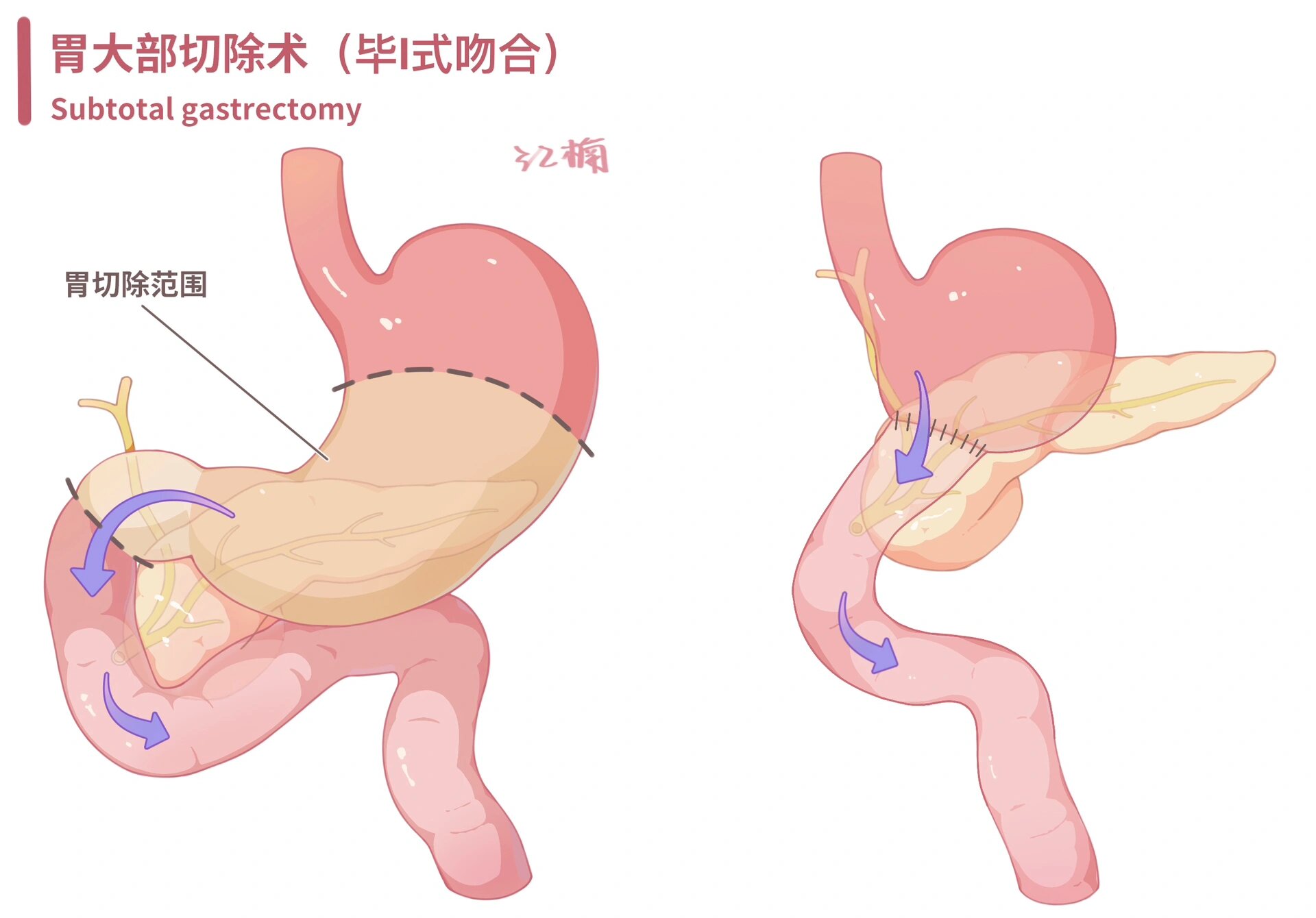 毕二式胃大部切除术图图片