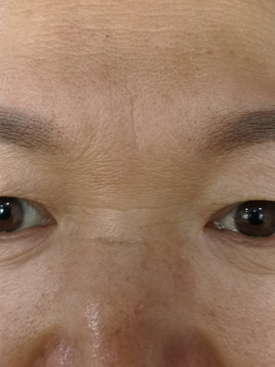 眼角纹抬头纹鼻背纹眉间纹可以使用药物注射除皱治疗