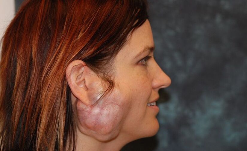 04腮腺肿瘤有哪些症状71 - 98 腮腺良性肿瘤 腮腺良性肿瘤除了