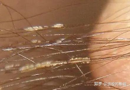 腋下汗毛白色附着物是什么东西洗不掉怎么去除