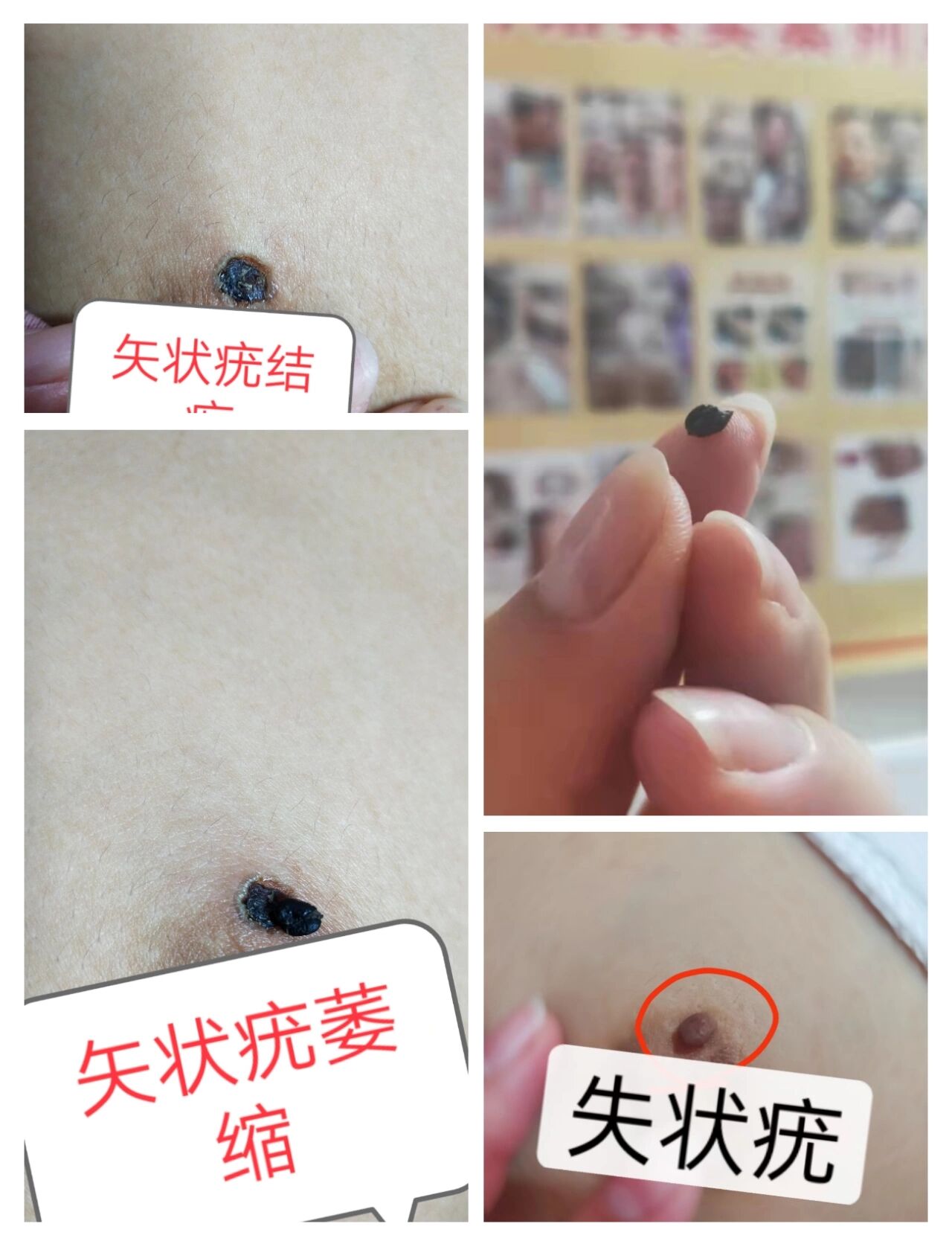 这么大的矢状疣见过没! 特大号矢状疣直接萎缩掉痂!