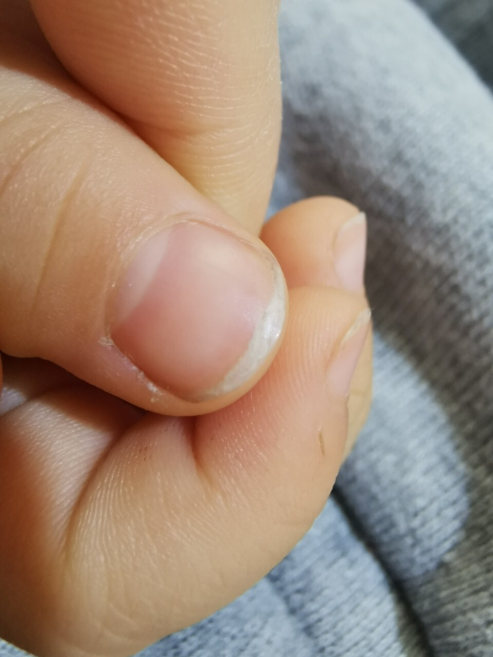 宝宝指甲分层,是缺钙吗?