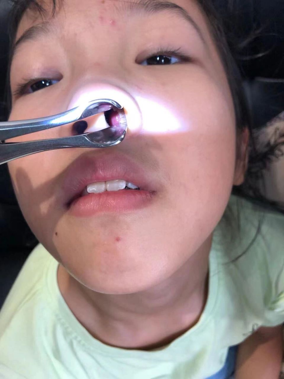 下鼻甲肥大症状表现:鼻塞,交替塞,打呼噜,张口呼吸,因下鼻甲积脓