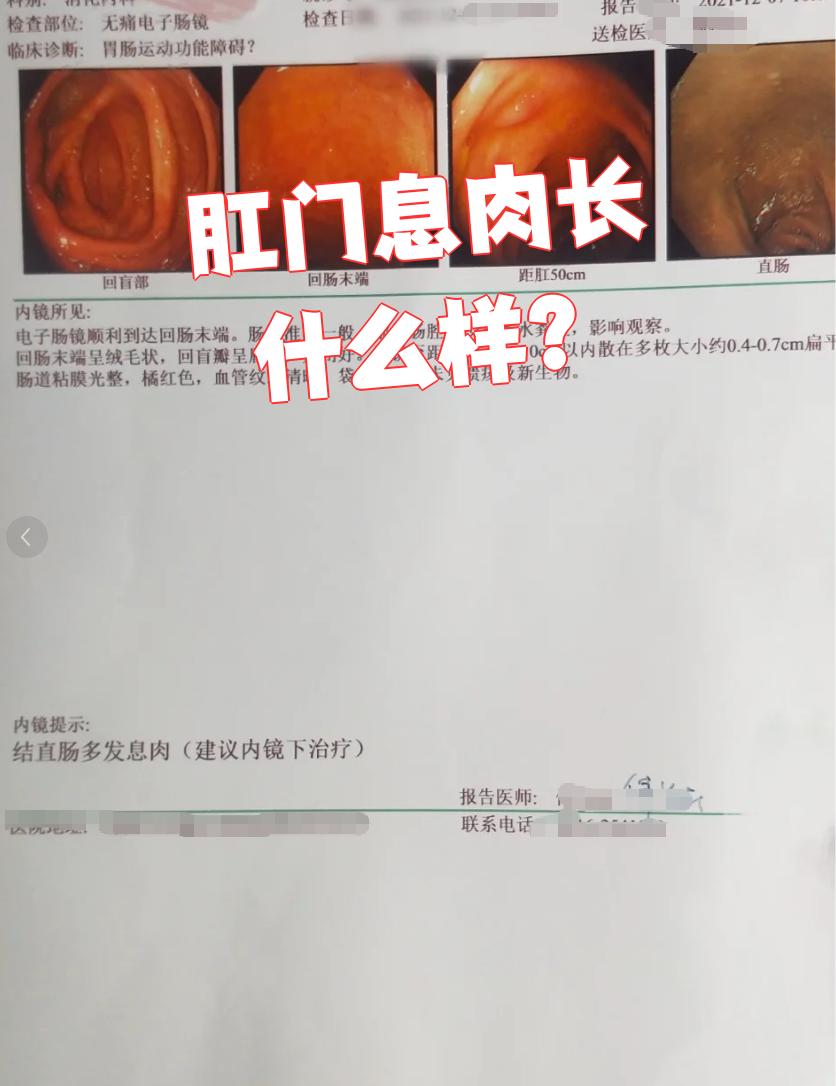 肛门息肉通常指的是肛乳头瘤,这种息肉一般不会自己消失,大多数歇要