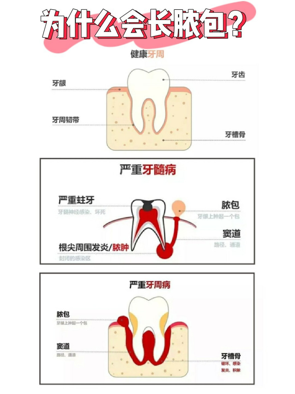 牙龈炎图片大全图解图片