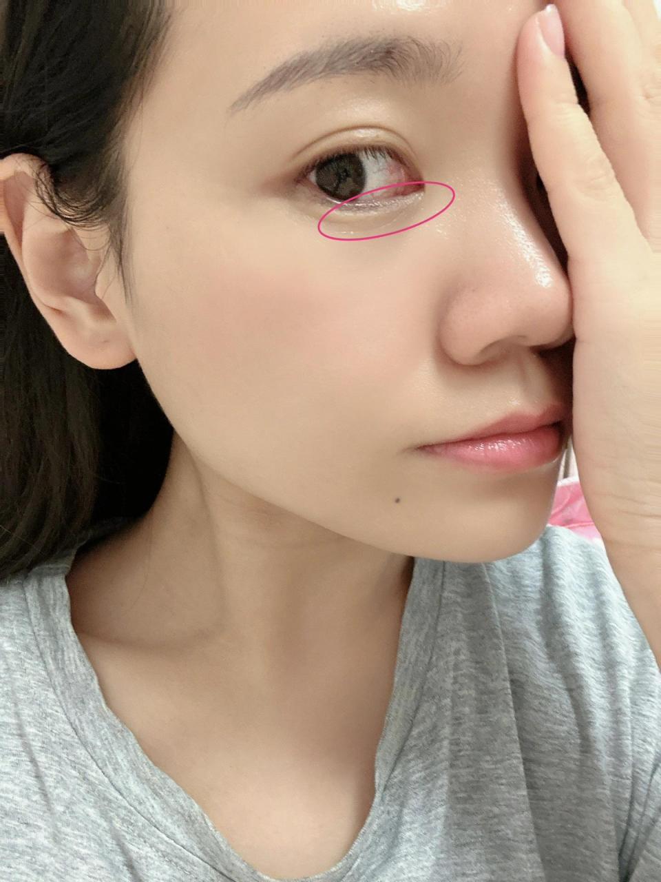 从小就一直被这道眼下纹烦恼 从小就一直被这道眼下纹烦恼,直到最近